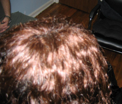 Top of Person's Head with New Hair