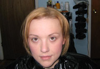 Before Trichotillomania Treatment, Front View